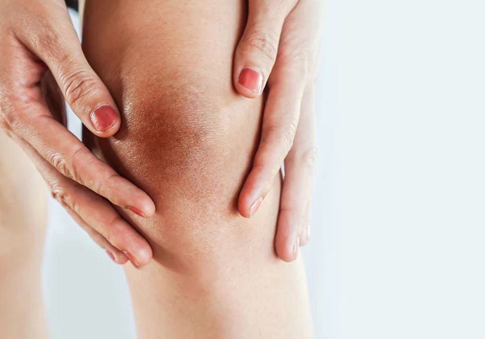 con gái bị thâm đầu gối vì sao